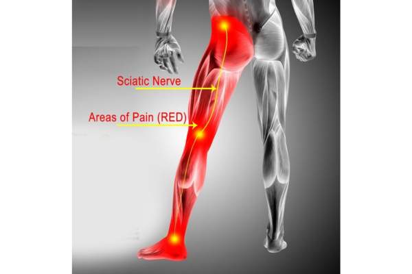 Sciatica Pain Diagram
