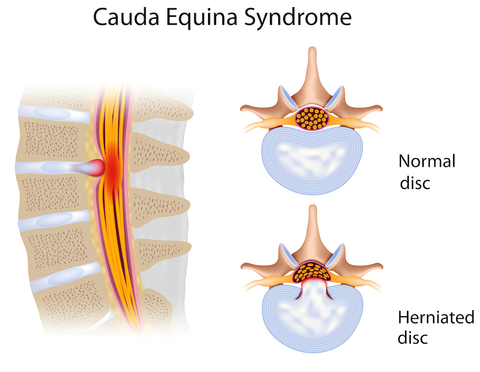Cauda Equina Syndrome